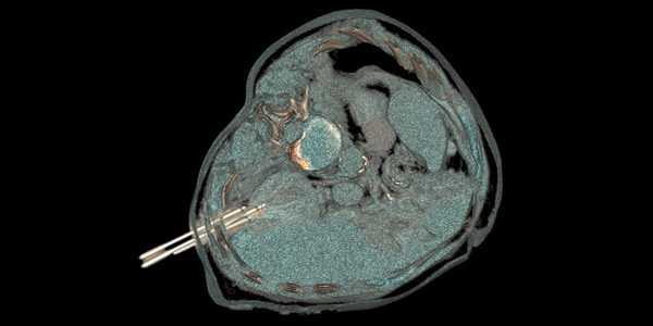 An innovative procedure of percutaneous cryoablation of a renal tumor 