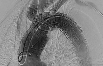 Fenestracja in-situ