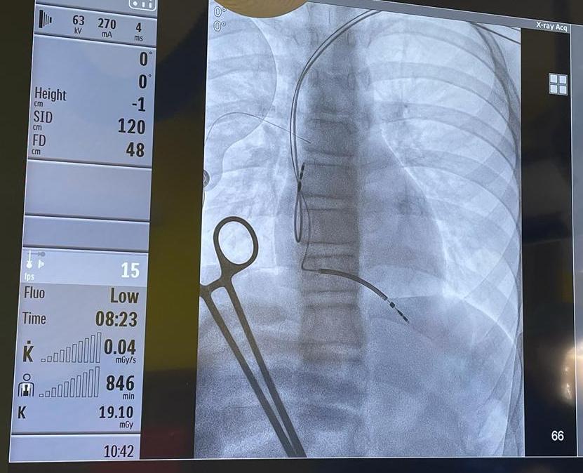 MUW specialists implanted the latest generation cardiac defibrillator in a pediatric patient