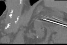 An innovative procedure of percutaneous cryoablation of a renal tumor 