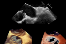 New technique for the treatment of tricuspid regurgitation