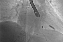 New technique for the treatment of tricuspid regurgitation