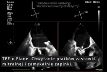 Pierwszy w Polsce zabieg przezskórnego leczenia ciężkiej niedomykalności mitralnej (TEER-MR) u chorego po przeszczepie serca