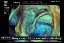 The first in Poland transcatheter procedure for severe mitral regurgitation (TEER-MR) in a heart transplant patient