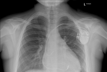 First physiological implantation of a pacing system in a child at the MUW