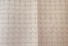 First physiological implantation of a pacing system in a child at the MUW