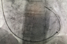 Innovative procedure for the treatment of refractory angina at the 1st Chair and Department of Cardiology, MUW